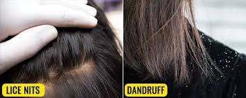 Image result for lice vs dandruff