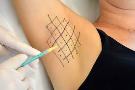 Pin En Botox Fillers