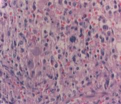 Bone marrow with myelod series dysplasia and scarce megakaryocytes.