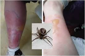 Initial bites from a black widow spider are often painless in their beginning stages and are commonly described as a pinprick sensation. Noble False Black Widow Spider News Noble False Black Widow Spider