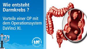 Darmkrebs Symptome Fruherkennung Minimiert Risiko Einer Op Vorteile Einer Davinci Xi Op Youtube