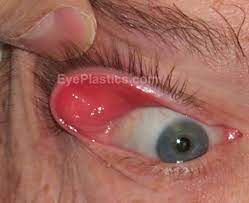 Eyelid bumps come in many forms, including styes, chalazia, xanthelasma, and milia. Floppy Eyelid Syndrome Eye Lid Laxity Ectropion Entropio Floppy Eyelid Laxity Trichiasis