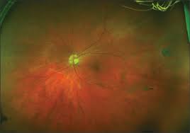 If a retinal tear were present what would likely be found when you evaluate the vitreous with the slit lamp biomicroscope? Optometric Management Ultra Widefield Retinal Imaging Is It Right For Your Practice