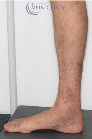 Image result for Stasis Dermatitis