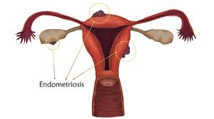 Endometriosis can be a challenging condition to manage. Endometriosis Davies Chicago Fertility Specialists Clinic Ivf In Vitro Infertility Doctordavies Chicago Fertility Specialists Clinic Ivf In Vitro Infertility Doctor