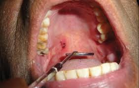 Most oral blood blisters develop following trauma to the mouth, such as biting your cheek, burning your mouth with hot food, or puncturing soft tissue with sharp food, like a chip. Blood Blister Causes Symptoms And Treatment
