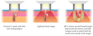 Make sure you follow all. Elos Hair Removal Estevan Laser Health Clinic