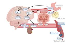 Image result for Cachexia in Cancer