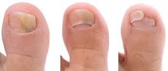 An infected nail may also become another home remedy to treat toenail fungus includes the use of apple cider vinegar. Definitive Guide Of Apple Cider Vinegar For Nail Fungus