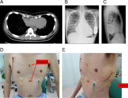 An implantable cardioverter defibrillator (icd) is a small electronic device connected to the heart. Successful Intermuscular Implantation Of Subcutaneous Implantable Cardioverter Defibrillator In A Japanese Patient With Pectus Excavatum Sciencedirect