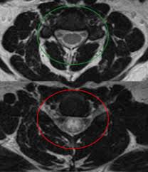 Transverse myelitis may occur alone or in combination with disease elsewhere in the nervous system. Transverse Myelitis Wikipedia