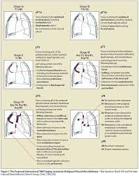 Malignant pleural mesothelioma (mpm) is a rare but aggressive tumor originating from the pleural cavity with a strong link to previous asbestos exposure. Pin On Mesothelioma