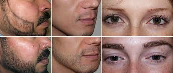 Transgender female to male patients (ftm) may also benefit from facial hair restoration. Facial Hair Transplant Imgur