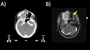 Image result for Incidental Imaging Finding