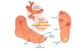 Jest ono rezultatem destrukcji głębokich tkanek w połączeniu z infekcją, jak również z zaburzeniami neurologicznymi oraz chorobami naczyń obwodowych w kończynach dolnych prowadzącymi do. Stopa Cukrzycowa Jak Ja Rozpoznac I Leczyc Polskie Stowarzyszenie Diabetykow