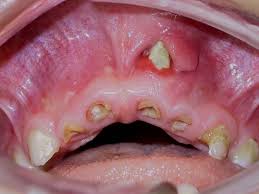 This affects the tissues that support teeth and hold them in place. Dental Health The Bc Pediatric Society