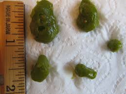 Why Wait Any Longer Rid Your Liver Gallbladder Of Toxic Stones Https Www Youtube Com Watch V E2sxdemoo54 By Jo Gallbladder Flush Liver Cancer Gallbladder