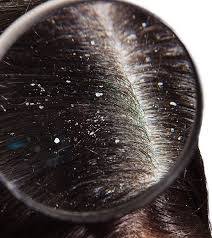 However, this does not mean dandruff causes graying. How To Get Rid Of Dandruff Grey Hairs Quora