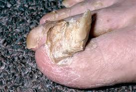 Image result for Onychogryphosis feet