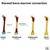 Bone Marrow Radiology Reference Article Radiopaedia Org