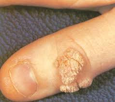Image result for verrucae filiformes