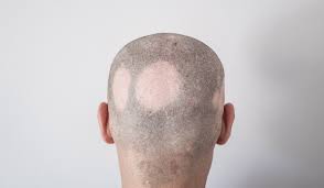 Alopecia areata is a condition where patches of hair loss develop, usually on the head. Wehret Den Anfangen Forum Das Wochenmagazin