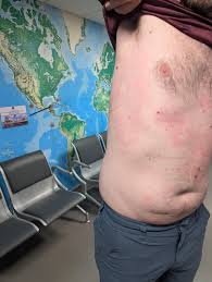 Image result for Decompression Sickness