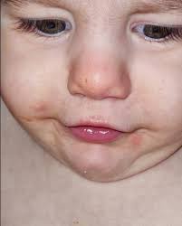 I have recently been diagnosed with diverticulitis after having terrible  cramps and diarrhea. I thought I had an intolerance to rapeseed oil but,  now Im not sure, it's exactly the same symptoms.