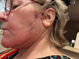 Ablation recovery: managing neck and jaw soreness