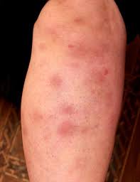 Image result for Panniculitis