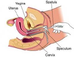 Serviks adalah bagian bawah rahim yang terhubung ke vagina. Seminar Deteksi Dini Upaya Pencegahan Kanker Serviks Dan Pemeriksaan Pap Smear Kamis 13 Oktober 2011 Universitas Esa Unggul