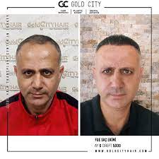 Ali Deniz 6 Ay 5000 Greft Sac