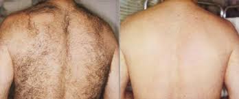 Get our professional laser hair removal services in conshohocken. Body Hair Removal Philadelphia Back Hair Removal For Men