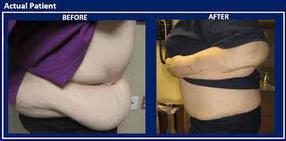 However, because an abdominoplasty focuses on appearance and is not medically necessary, it is considered a cosmetic treatment and tends not to be covered by insurance. Panniculectomy Reno Excess Skin Removal Sasse Surgical Associates