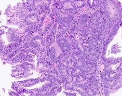 ↓ see below for any exclusions, inclusions or special notations n84.1 also applies to the following: Pathology Outlines Endometrial Hyperplasia