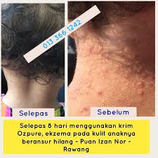Ketidakseimbangan sistem kekebalan tubuh memainkan peranan dalam perkembangan keadaan ini dan faktor pencetus. Ubat Gatal Ekzema Bayi Kurap Panau Kayap Gatal Kulit Badan Kaki Kemaluan Faraj Vagina Ozpure Shopee Malaysia