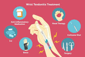 Dequervain S Tenosynovitis Sakit Dekat Pergelangan Tangan Biasa Berlaku Wanita Selepas Bersalin Mingguan Wanita