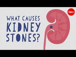 Kidney Stones Symptoms Complications And Removal