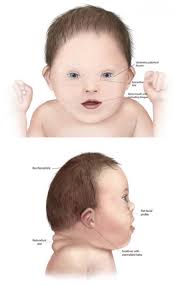Is also not a big deal. Facts About Down Syndrome Cdc