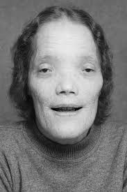 Film: “Kenny” aka “The Kid Brother” c. 1988. Kenny Easterday was born in  1974 in West Aliquippa, Pennsylvania with only half a spine, a rare  condition called Sacral Agenesis. When he was