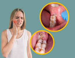 Wisdom Tooth Pain Explained: Common Causes, Symptoms, and Treatment Option  - crystalline Dental