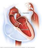 Image result for icd 10 code for aortic coarctation