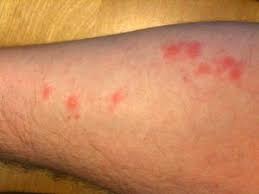 Allergic Reaction Black Ant Bites Pictures Pin On Bug Bites