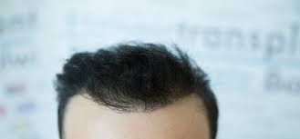 Wenn die in einen anderen innerhalb der ersten 15 tage fallen die krusten während des regelmäßigen täglichen kopfwaschens ab. Haartransplantation Und Haare Fallen Wieder Aus Woran Liegt Das