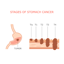 Stomach cancer, in its early stages, rarely shows any warning signs or symptoms.due to its gradual and seemingly silent progress, stomach cancer is usually hard to detect in its early stages. Early Symptoms Of Stomach Cancer èƒƒç™Œçš„æ—©æœŸç—‡ç‹€ è‹±æ–‡ China Medical University Hospital