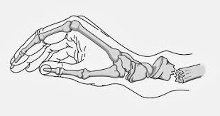 Resultado de imagem para rx com fraturas