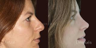 Veronica's Case : Before and after Rhinoplasty : FB