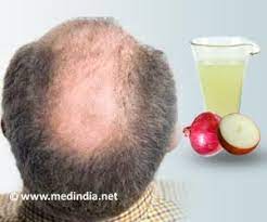 By doing this onion hair loss and balding treatment everyday, you may find a great transformation of the hair on your head in several months. Onions And Hair Loss