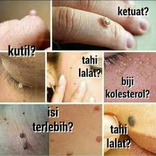 Kemudian jika tahi lalat terletak di alis mata sebelah kanan, maka kalian akan menikah dengan pasangan yang. Macam Macam Produk Buang Tahi Ubat Buang Tahi Lalat Facebook