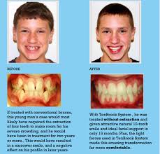 Part of how long it takes depends on you, too. What S The Fastest Way To Straighten Your Teeth